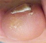 足爪が肥厚爪・白濁爪の状態から回復